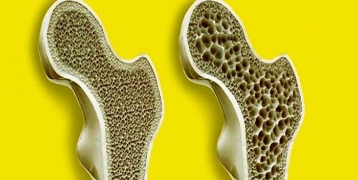 12 توصیه برای اینکه پوکی استخوان نگیرید